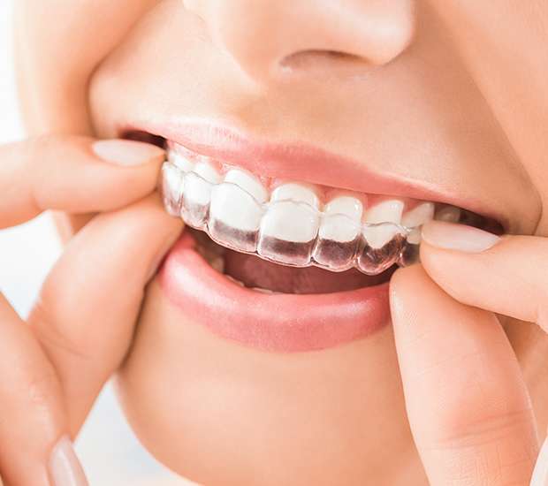 Roanoke Does Invisalign Really Work